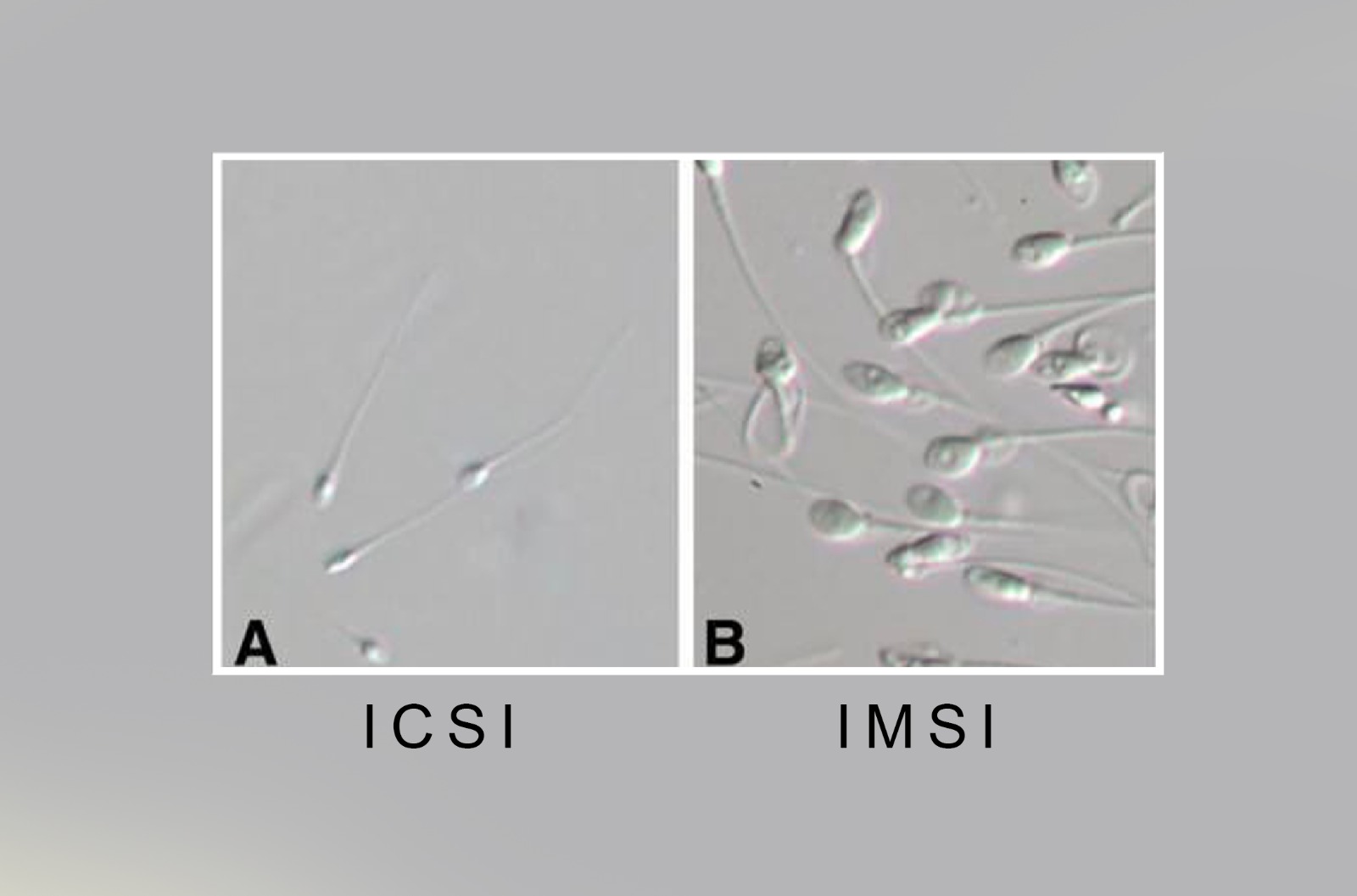 IMSI : INTRA CYTOPLASMIC MORPHOLOGICAL SPERM INJECTION